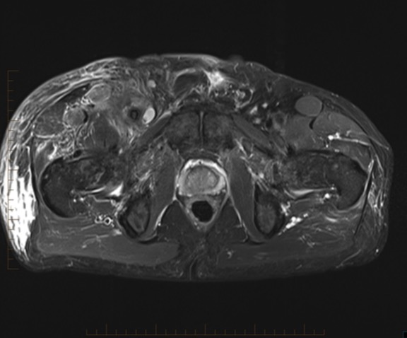 Figure 5 for case Vascular leiomyosarcoma ( RID4387 )